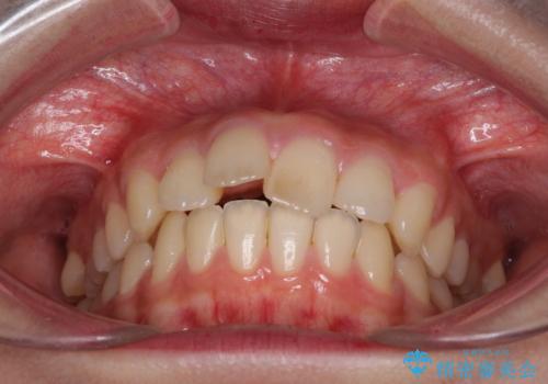 就職前にきれいな歯並びにしたい 大学生のインビザライン矯正の治療前