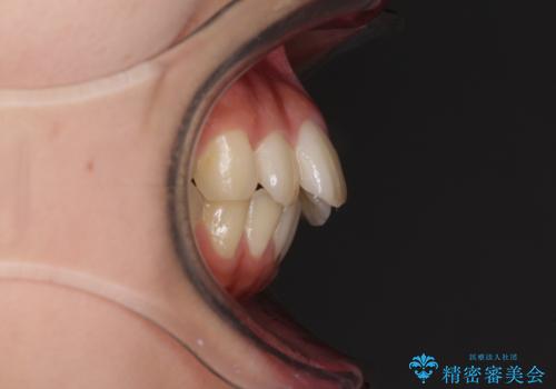 就職前にきれいな歯並びにしたい 大学生のインビザライン矯正の治療前