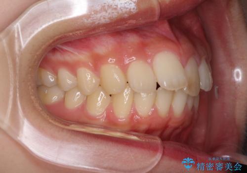 就職前にきれいな歯並びにしたい 大学生のインビザライン矯正の治療前