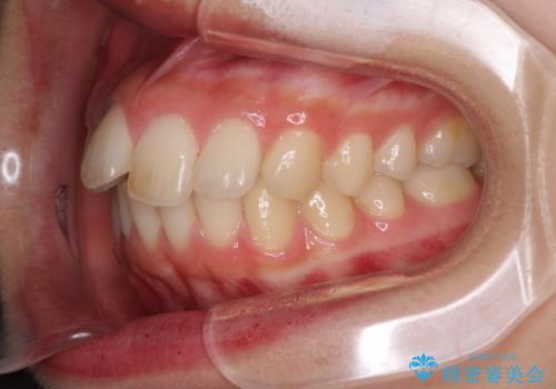 就職前にきれいな歯並びにしたい 大学生のインビザライン矯正の治療前