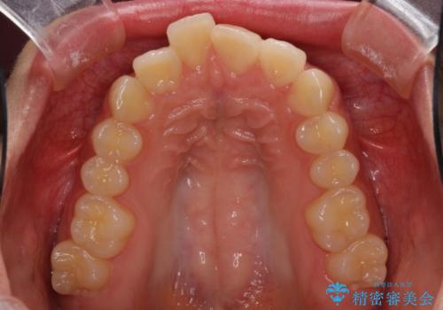 就職前にきれいな歯並びにしたい 大学生のインビザライン矯正の治療前