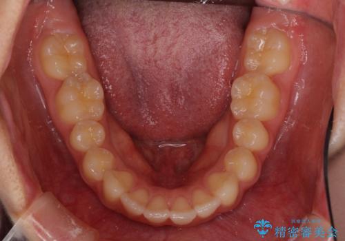 就職前にきれいな歯並びにしたい 大学生のインビザライン矯正の治療前
