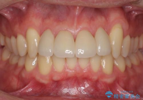 前歯のすき間 セラミックで綺麗に 最短で治療の治療後