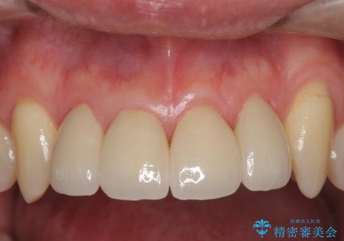 前歯のすき間　セラミックで綺麗に　最短で治療の症例 治療後