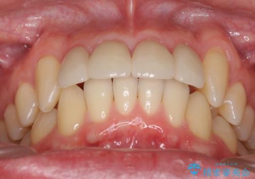 前歯のすき間　セラミックで綺麗に　最短で治療の治療後
