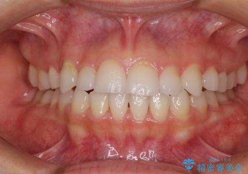 目立ちにくい抜歯矯正 ハーフリンガルの症例 治療後