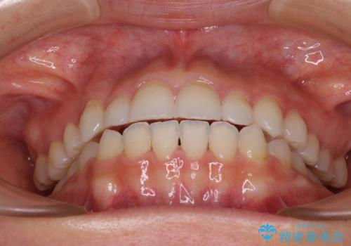 目立ちにくい抜歯矯正 ハーフリンガルの治療後