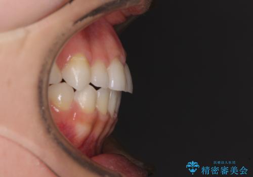 目立ちにくい抜歯矯正 ハーフリンガルの治療後
