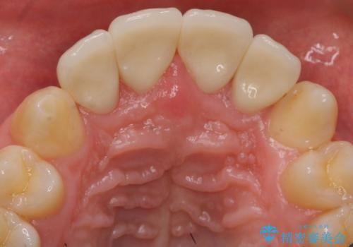 前歯のすき間 セラミックで綺麗に 最短で治療の治療後