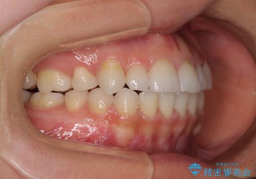 目立ちにくい抜歯矯正 ハーフリンガルの治療後