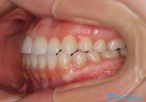 目立ちにくい抜歯矯正 ハーフリンガルの治療後