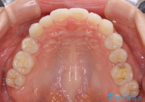 目立ちにくい抜歯矯正 ハーフリンガルの治療後