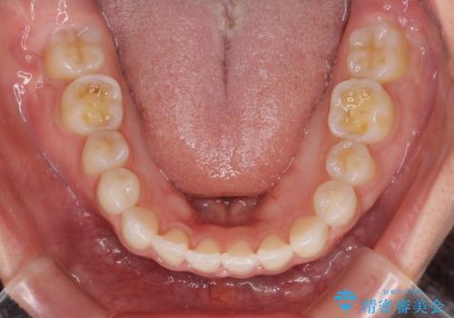 目立ちにくい抜歯矯正 ハーフリンガルの治療後