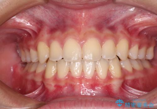 気がつくと口が開いてしまう　閉じにくい口元改善の抜歯矯正の症例 治療後