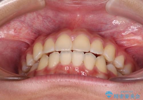 気がつくと口が開いてしまう 閉じにくい口元改善の抜歯矯正の治療後