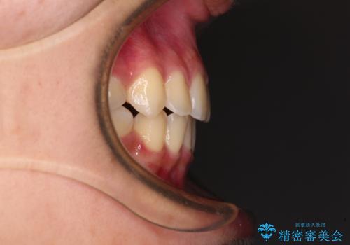 気がつくと口が開いてしまう 閉じにくい口元改善の抜歯矯正の治療後