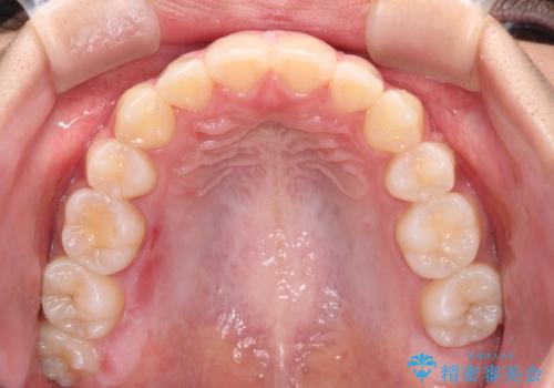 気がつくと口が開いてしまう 閉じにくい口元改善の抜歯矯正の治療後