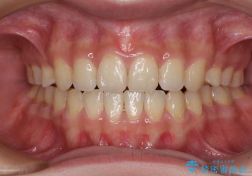 話しにくいオープンバイト ワイヤー装置による抜歯矯正治療の症例 治療後