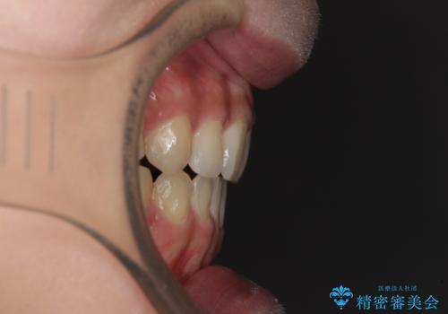 話しにくいオープンバイト ワイヤー装置による抜歯矯正治療の治療後