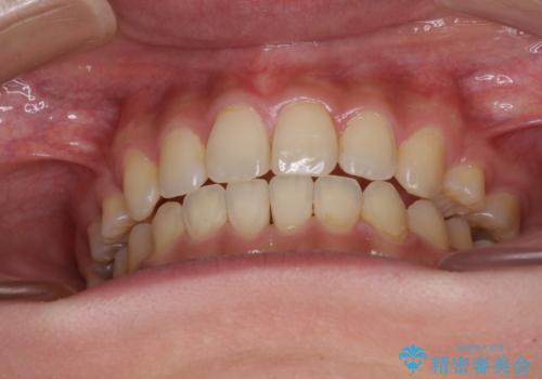 話しにくいオープンバイト ワイヤー装置による抜歯矯正治療の治療後