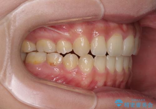 話しにくいオープンバイト ワイヤー装置による抜歯矯正治療の治療後
