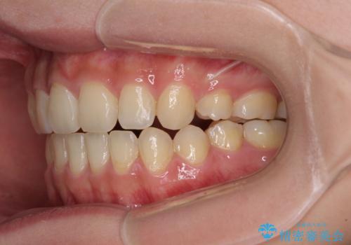話しにくいオープンバイト ワイヤー装置による抜歯矯正治療の治療後