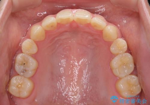 話しにくいオープンバイト ワイヤー装置による抜歯矯正治療の治療後