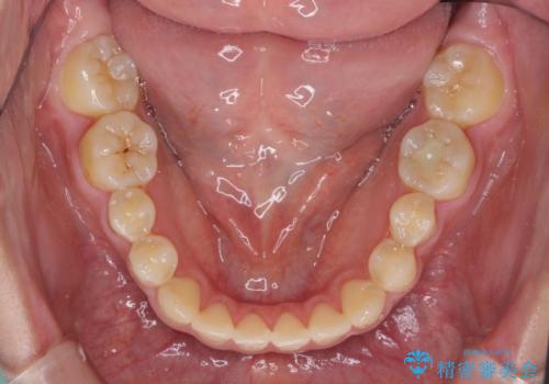 話しにくいオープンバイト ワイヤー装置による抜歯矯正治療の治療後