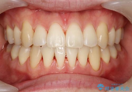 プラークなどによる歯の黄ばみの症例 治療後