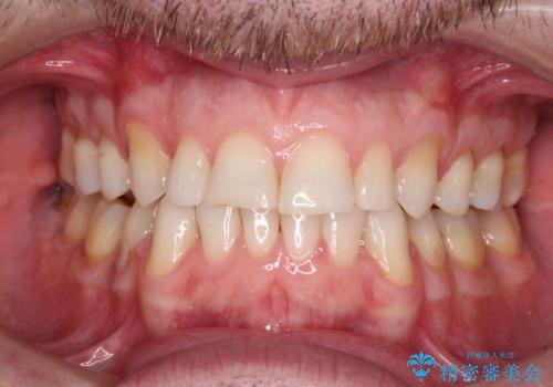 抜歯矯正の後戻りが気になる インビザライン・ライトによる矯正治療の症例 治療後