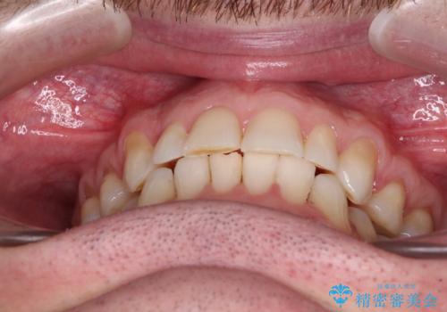 抜歯矯正の後戻りが気になる インビザライン・ライトによる矯正治療の治療後