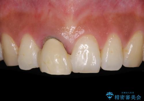 折れているのに応急処置でごまかしてきた前歯 オールセラミックブリッジによる補綴治療の治療前