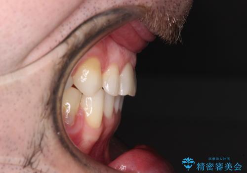 抜歯矯正の後戻りが気になる インビザライン・ライトによる矯正治療の治療後