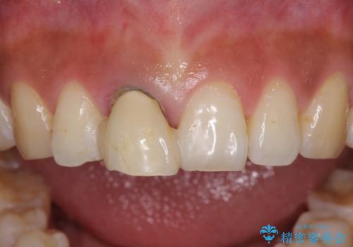 折れているのに応急処置でごまかしてきた前歯 オールセラミックブリッジによる補綴治療の治療前