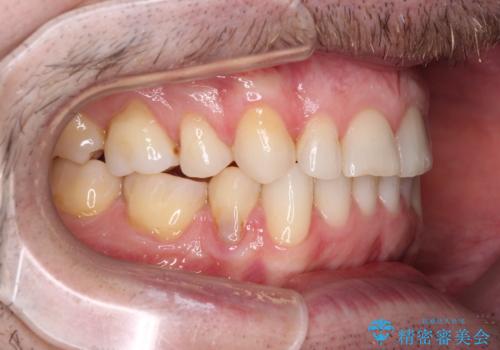 抜歯矯正の後戻りが気になる インビザライン・ライトによる矯正治療の治療後