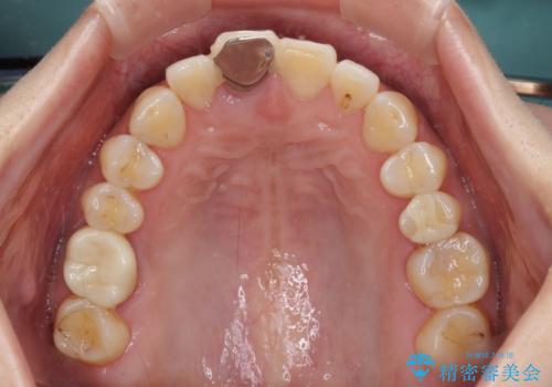 折れているのに応急処置でごまかしてきた前歯 オールセラミックブリッジによる補綴治療の治療前