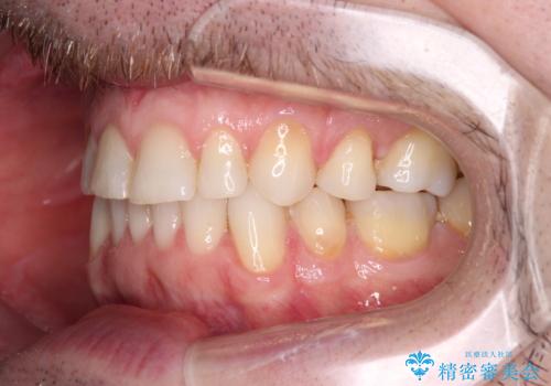 抜歯矯正の後戻りが気になる インビザライン・ライトによる矯正治療の治療後