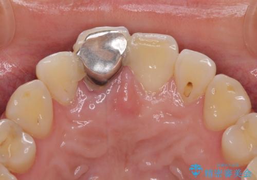 折れているのに応急処置でごまかしてきた前歯 オールセラミックブリッジによる補綴治療の治療前