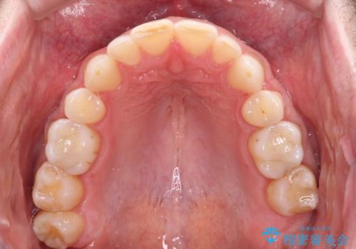 抜歯矯正の後戻りが気になる インビザライン・ライトによる矯正治療の治療後