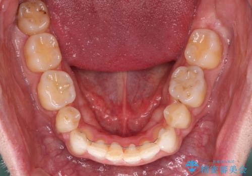 抜歯矯正の後戻りが気になる インビザライン・ライトによる矯正治療の治療後