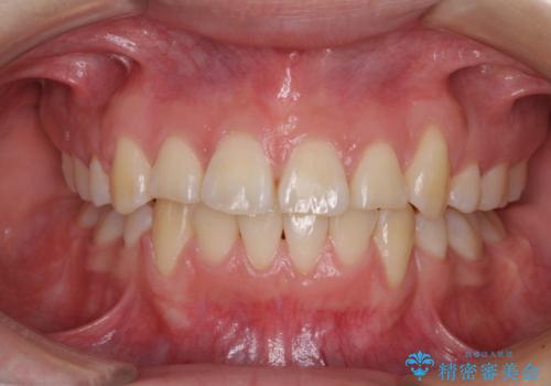前歯が磨きにくい　目立たないワイヤー装置による矯正治療の症例 治療後