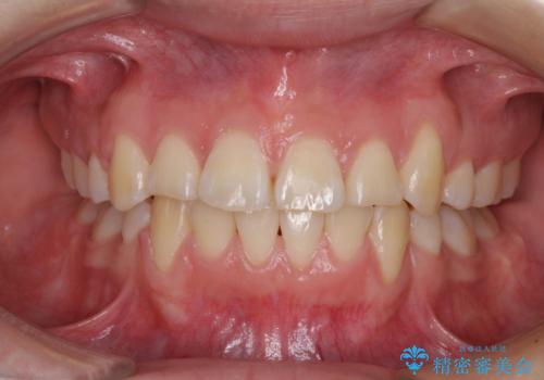 前歯が磨きにくい　目立たないワイヤー装置による矯正治療の治療後