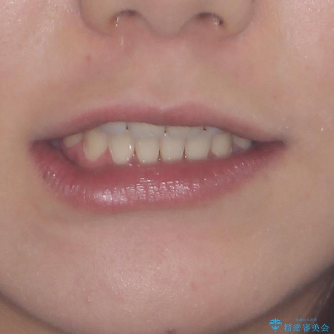 話しにくいオープンバイト ワイヤー装置による抜歯矯正治療の治療後(顔貌)