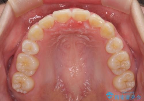 前歯が磨きにくい　目立たないワイヤー装置による矯正治療の治療後