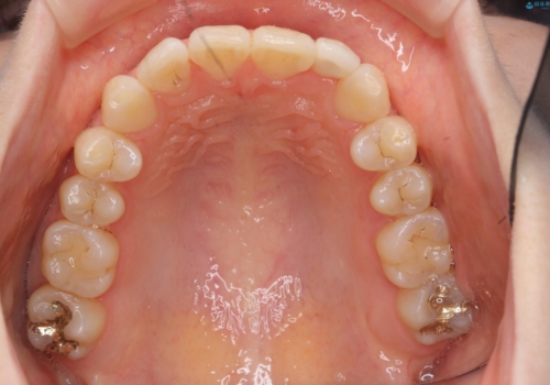 前歯が気になる 大人のマウスピース矯正 矮小歯を整えるの治療後