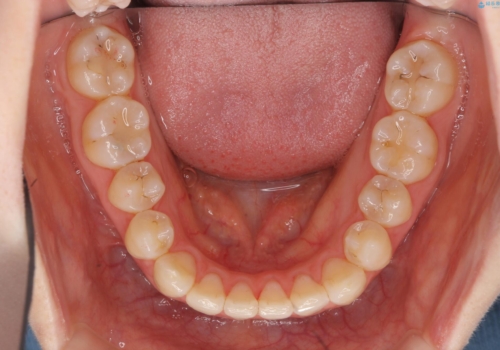 前歯が気になる 大人のマウスピース矯正 矮小歯を整えるの治療後