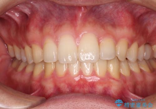 前歯のクロスバイトと抜歯が必要な奥歯の虫歯　インビザラインとインプラント治療の症例 治療後