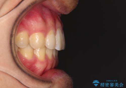 前歯のクロスバイトと抜歯が必要な奥歯の虫歯 インビザラインとインプラント治療の治療後