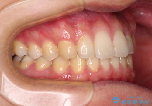 前歯のクロスバイトと抜歯が必要な奥歯の虫歯 インビザラインとインプラント治療の治療後