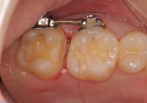奥歯の虫歯 歯の間を広げてセラミックでしっかり治療の治療中